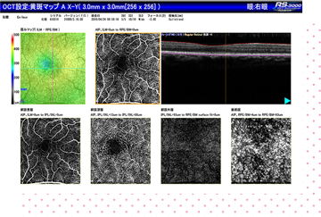 OCT-Angiographyによる高精細な画像で正確な診断が可能です